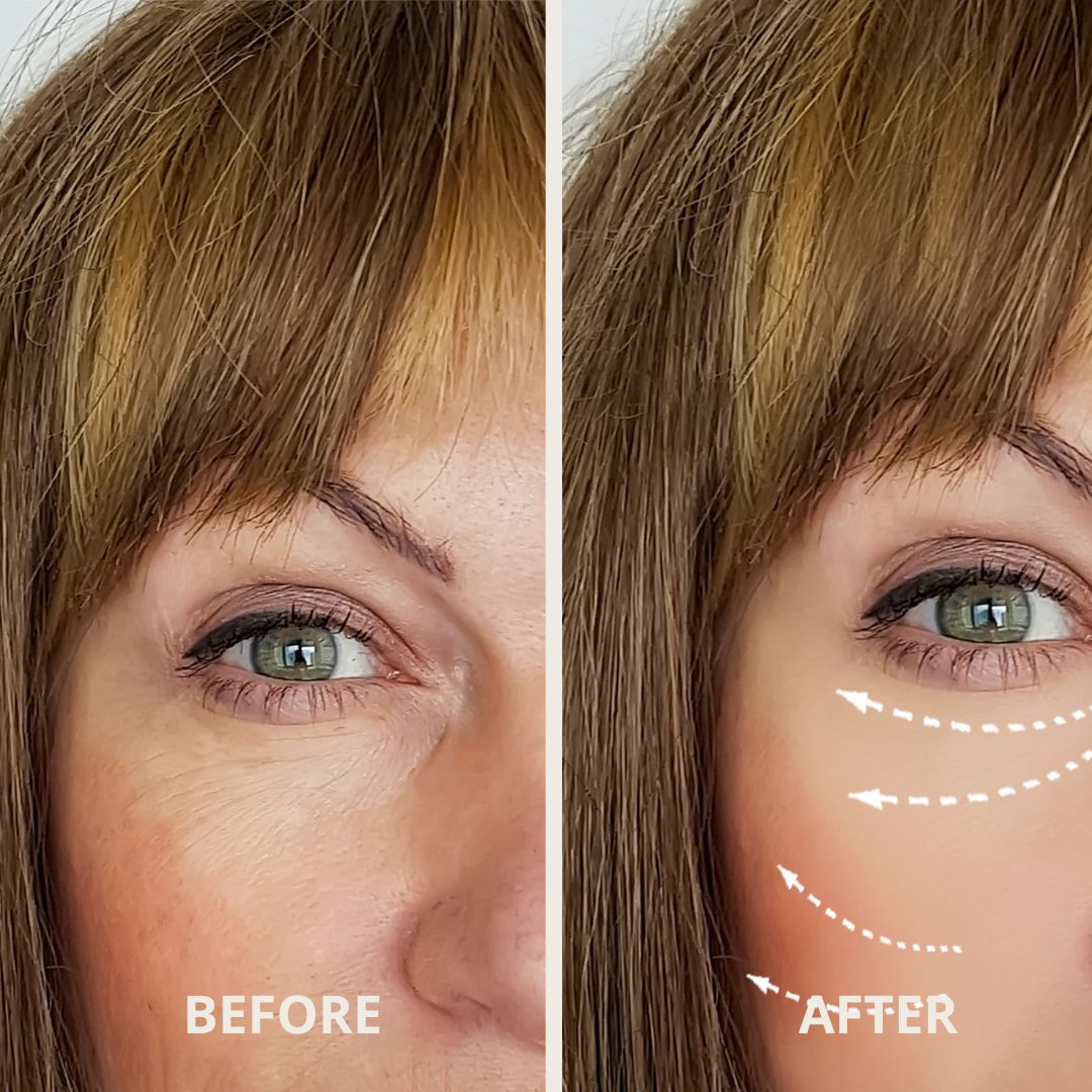 AURORA™ Advanced Under-Eye Renewal Therapy